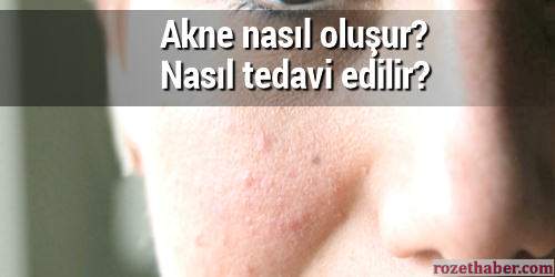 Akne nasıl oluşur nasıl tedavi edilir Haberi Akne nasıl oluşur nasıl tedavi edilir resmi