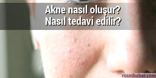 Akne nasıl oluşur nasıl tedavi edilir