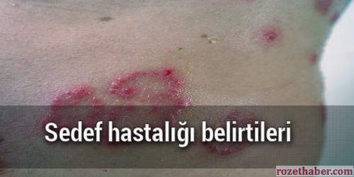 Sedef hastalığı belirtileri Sedef hastalığı belirtileri